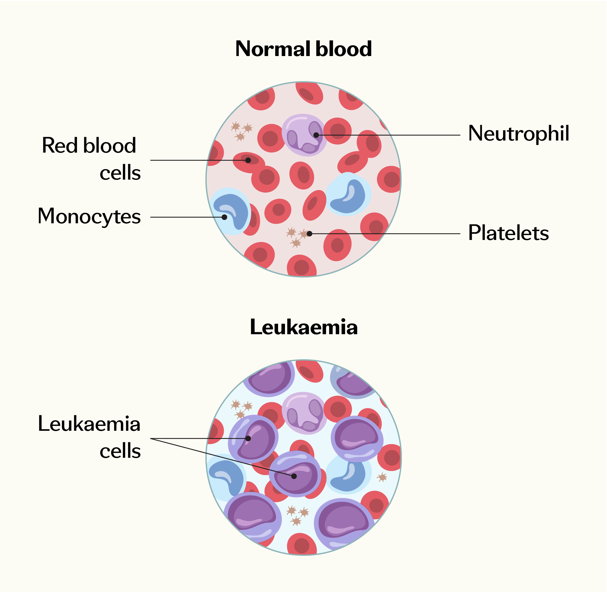 Comparison of normal blood and leukaemia, showing red blood cells, neutrophils, monocytes, platelets, and leukaemia cells.
