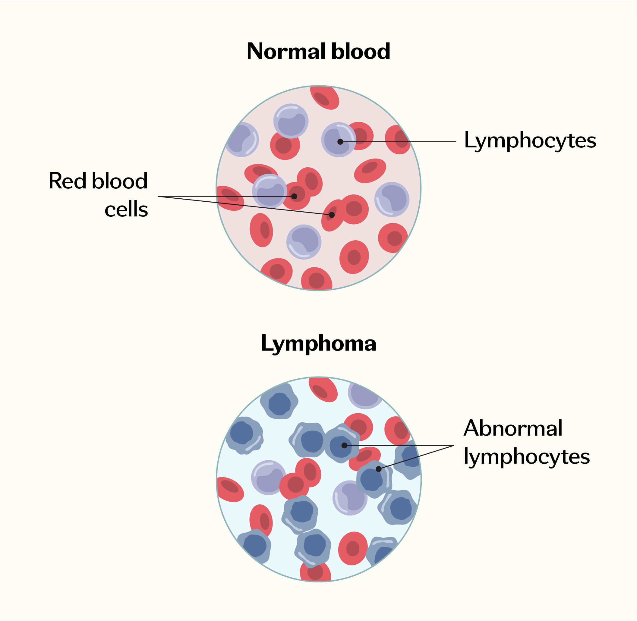 Comparison of normal blood and lymphoma showing red blood cells, lymphocytes, and abnormal lymphocytes.