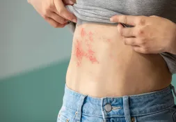 Person lifting their shirt to reveal a red, irritated rash on their torso.